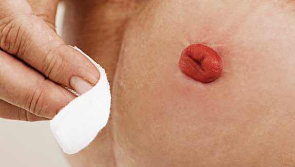 close-up-of-hand-caring-for-the-skin-around-a-stoma